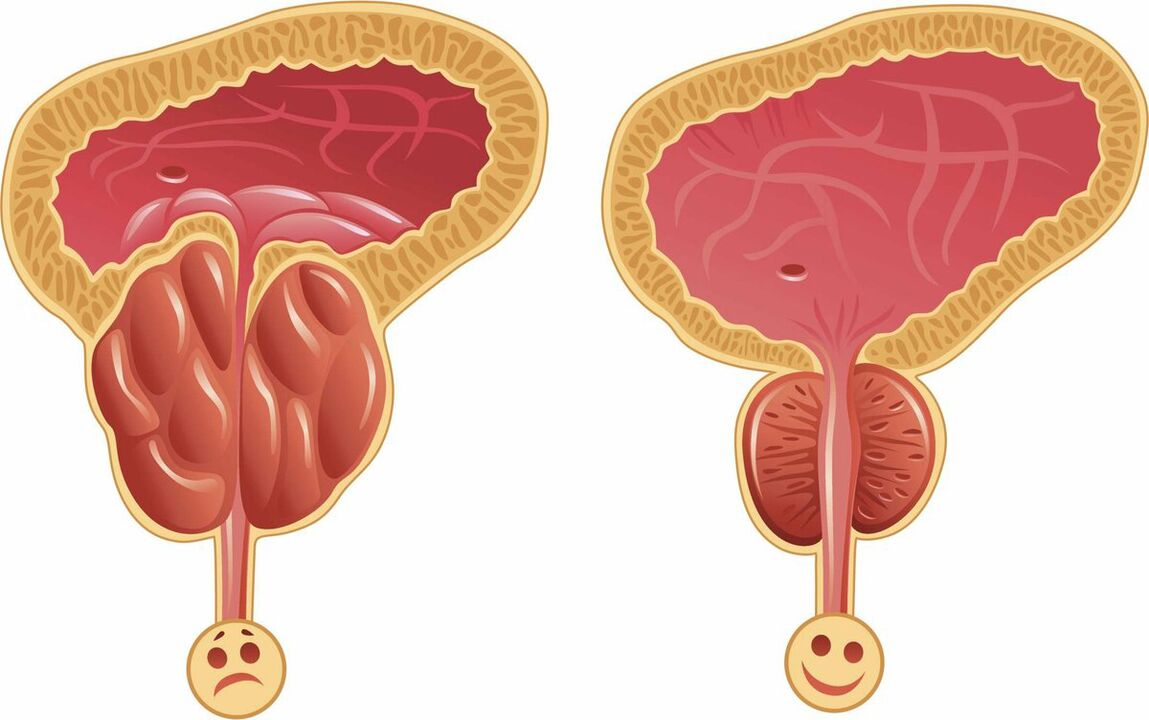 Próstata antes e despois do tratamento con cápsulas Prostaffect