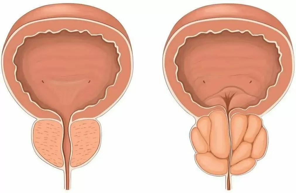 próstata normal e próstata enferma