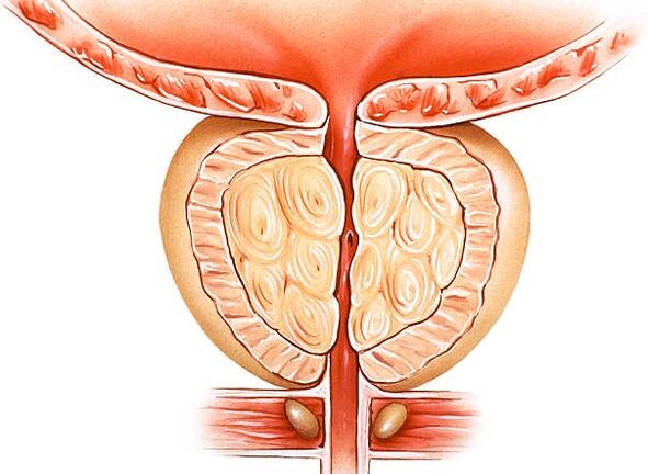 ilustración de próstata inflamada
